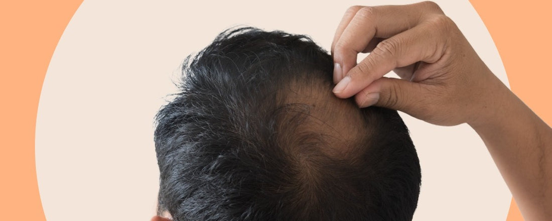 Top 5 Best Bald Hair Shampoo In India