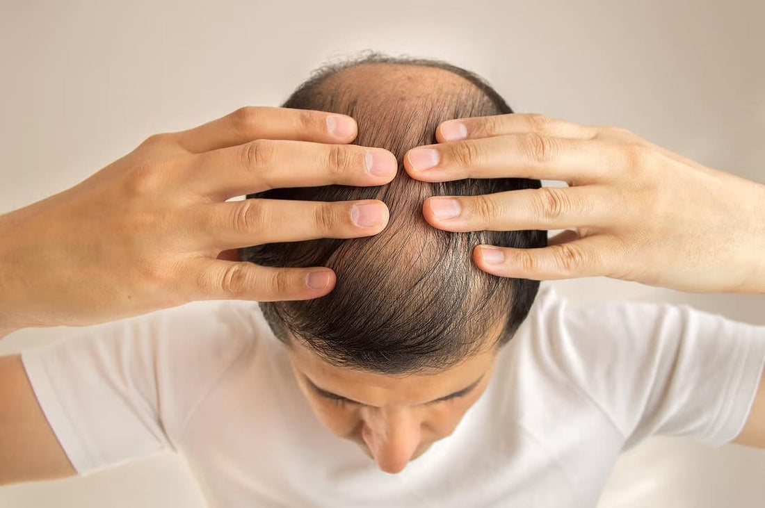 Top 6 Anti Bald Hair Oil as in India