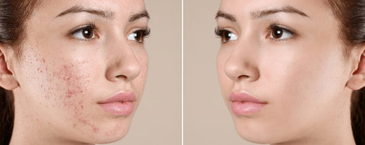 Top 5 Best Anti Acne Face Cream In India