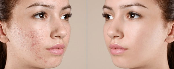 Top 5 Best Anti Acne Face Cream In India