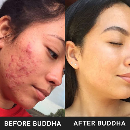 buddha natural 21 day acne facial kit before after image
