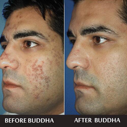 buddha Natura Anti Acne Face Wash - customer reviews 