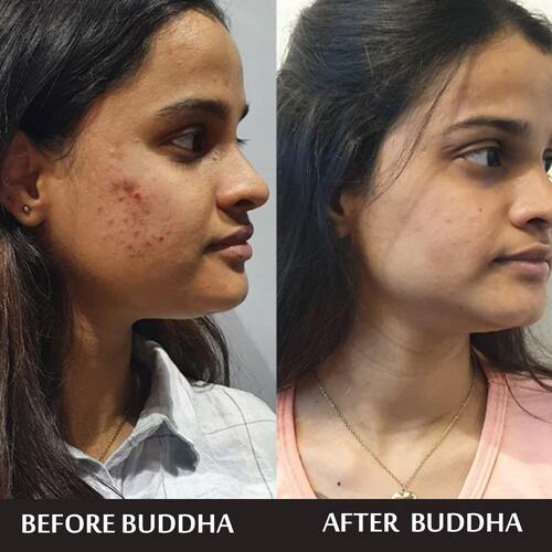 buddha Natura Anti Acne Face Wash - customer reviews