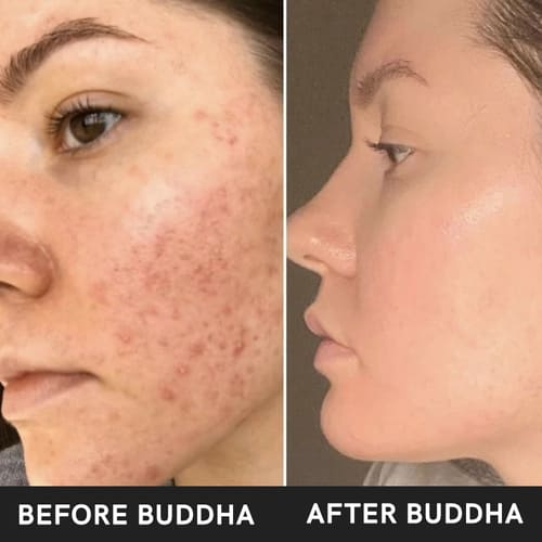 buddha natural anti acne face ubtan before after image 