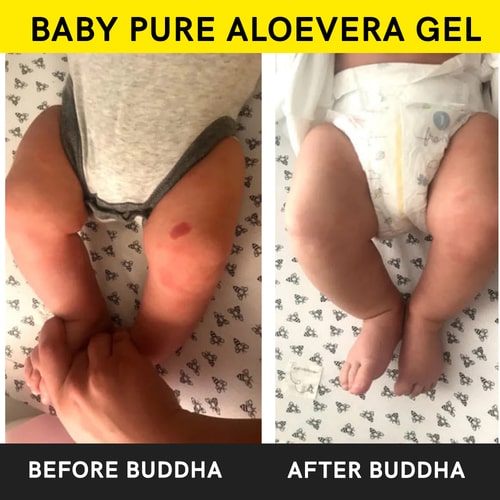 Buddha Natural Baby Pure Aloe Vera Gel - before and after use 