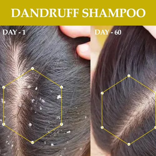 Anti Dandruff Shampoo - 100% Ayush Certified - For Serene Scalp Wellness and Flake-Free Hair