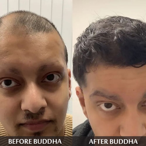 Buddha natural Anti Bald Hair Oil - customer reviews - best oil to grow hair on bald patches